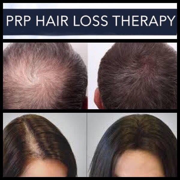 Top 5 Benefits of PRP Hair Restoration - A Better You