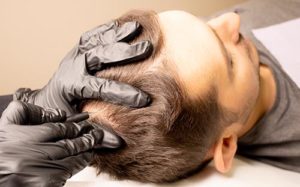 a man undergoes prp treatment for hair loss
