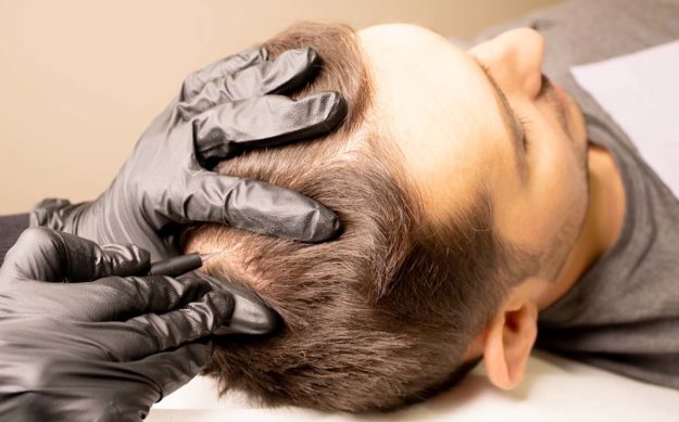 What is PRP Hair Restoration a man receives a prp hair restoration treatment at a medispa to boost his confidence and look and feel his best