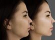 Profile of a woman who had Kybella, prompting her to ask "how long does Kybella last?"